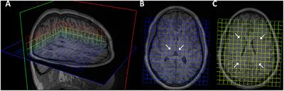 Longitudinal Changes in Magnetic Resonance Spectroscopy in Pediatric Concussion: A Pilot Study